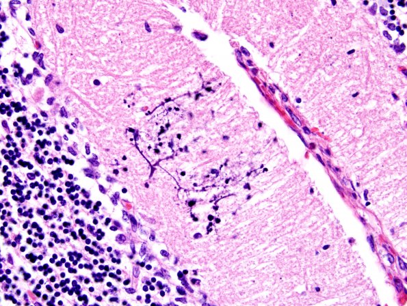 5B8 H-I, neonatal, HLH, noHIV (Case 5) N9 H&E 4 - Copy