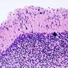 5B9 H-I, neonatal, HLH, noHIV (Case 5) N9 H&E 10