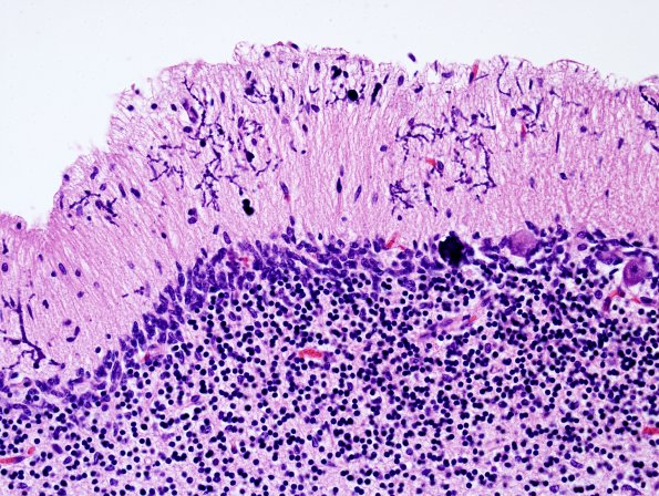 5B9 H-I, neonatal, HLH, noHIV (Case 5) N9 H&E 10