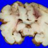 1A1 Infarcts, watershed, neonatal (Case 1)  2