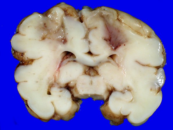 1A1 Infarcts, watershed, neonatal (Case 1)  2