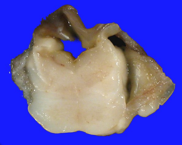 1A2 Infarcts, watershed, neonatal (Case 1) 13