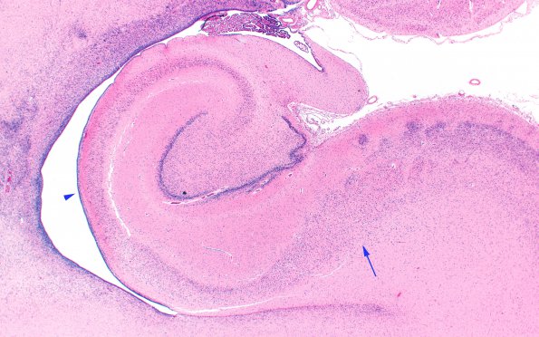 1B2 Hypoxia, neonatal, PSN (Case 1) Sub H&E 2X copy