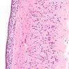 1B3 Hypoxia, neonatal, PSN (Case 1) Sub H&E 20X CA1