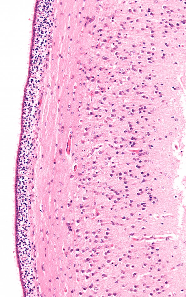 1B3 Hypoxia, neonatal, PSN (Case 1) Sub H&E 20X CA1