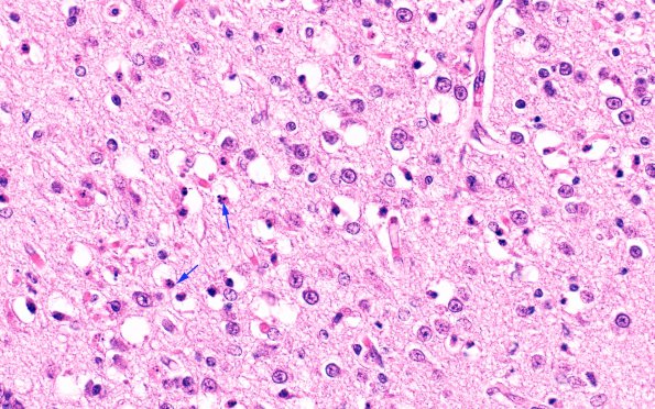 1B4 Hypoxia, neonatal, PSN (Case 1) Sub H&E 40X copy