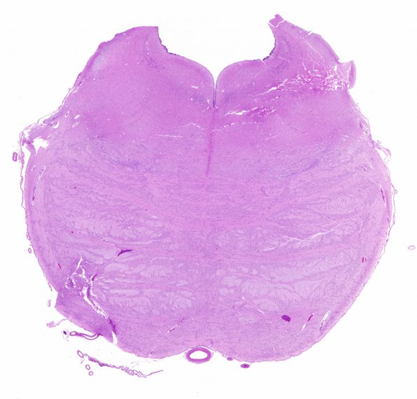 1C1 Hypoxia, neonatal, Pontosubicular Necrosis (Case 1) Pons H&E whole mount