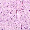 1C2 Hypoxia, neonatal, Pontosubicular Necrosis (Case 1) Pons H&E 1