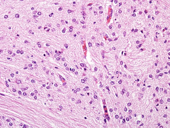 1C2 Hypoxia, neonatal, Pontosubicular Necrosis (Case 1) Pons H&E 1