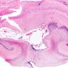 2B1 Hypoxia Ischemia, neonatal (Case 2) (PSN) H&E 2X copy