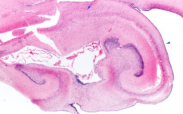 2B1 Hypoxia Ischemia, neonatal (Case 2) (PSN) H&E 2X copy