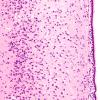 2B2 Hypoxia Ischemia, neonatal (Case 2) (PSN) H&E 3 CA1