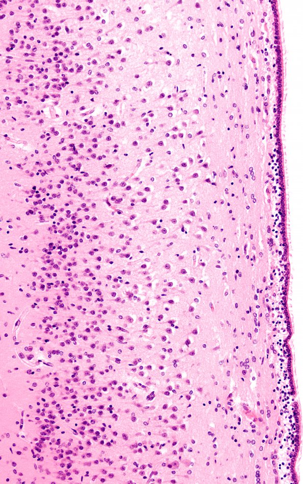 2B2 Hypoxia Ischemia, neonatal (Case 2) (PSN) H&E 3 CA1