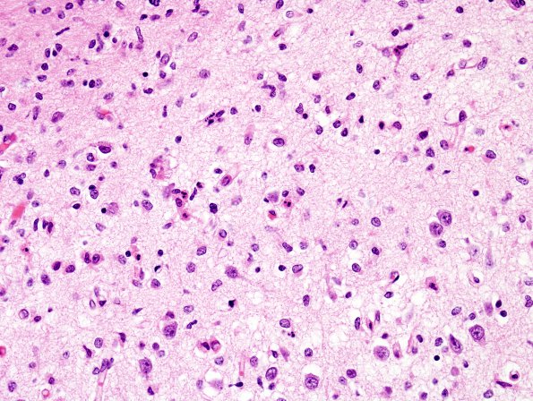 2B3 Hypoxia Ischemia, neonatal (Case 2) (PSN) H&E 3