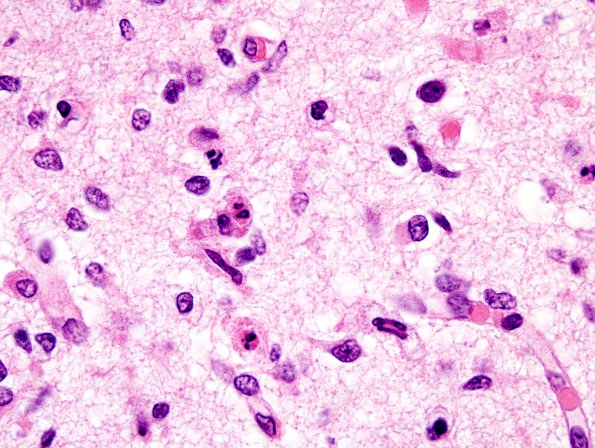 2B4 Hypoxia-Ischemia (Case 2) apoptosis Hippo H&E 1