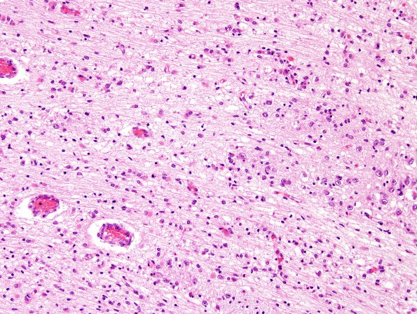 2C1 Hypoxia-Ischemia (Case 2) Pons H&E 6