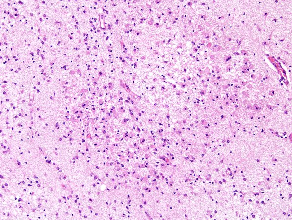 2D1 Hypoxia-Ischemia (Case 2) WM H&E 4