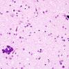 2D2 Hypoxia-Ischemia (Case 2) WM H&E 5