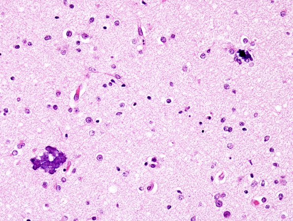 2D2 Hypoxia-Ischemia (Case 2) WM H&E 5