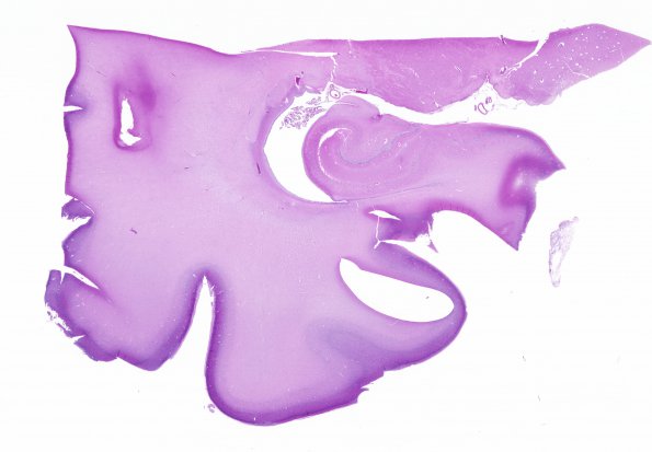 3A1 Hypoxia-Ischemia, Pontosubicular (Case  3) H&E whole mount