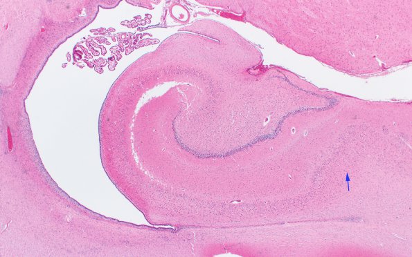 3A2 Hypoxia-Ischemia, Pontosubicular (Case  3) H&E 2X