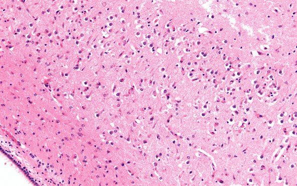 3A3 Hypoxia-Ischemia, Pontosubicular (Case  3) H&E 20X CA1