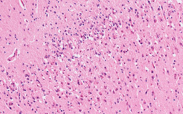 3A4 Hypoxia-Ischemia, Pontosubicular (Case  3) H&E 20X Sub