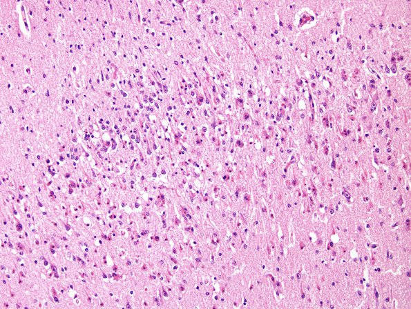 3A5 Hypoxia-Ischemia, Pontosubicular (Case  3) H&E 6