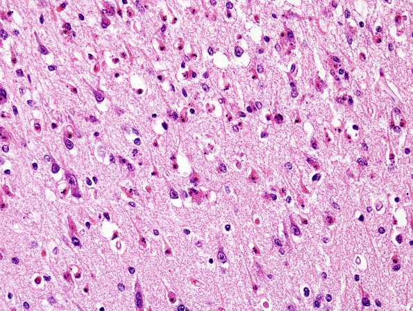 3A6 Hypoxia-Ischemia, Pontosubicular (Case  3) H&E 5