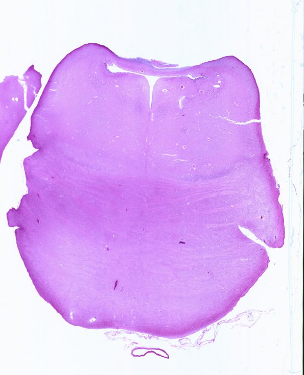 3B1 Hypoxia-Ischemia, Pontosubicular (Case  3) N7 H&E WM