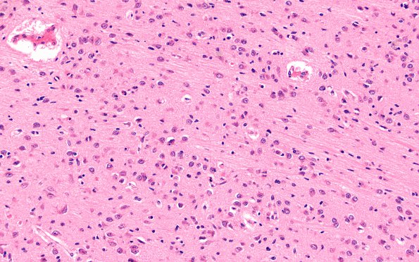 3B2 Hypoxia-Ischemia, Pontosubicular (Case  3) H&E 20X Pons