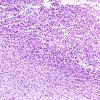 4B1 Hypoxia-ischemia, PSN (Case  4) N4 subiculum H&E 10X