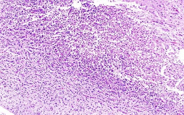 4B1 Hypoxia-ischemia, PSN (Case  4) N4 subiculum H&E 10X