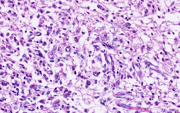 4B2 Hypoxia-ischemia, PSN (Case  4) N4 sub H&E 40X