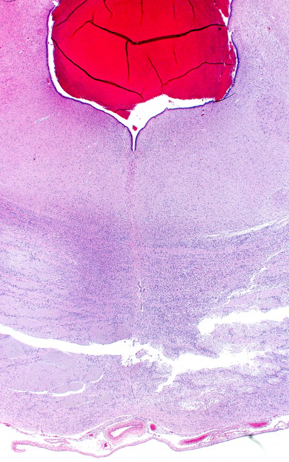 4C1 Hypoxia-Ischemia, PSN (Case  4) H&E 2X