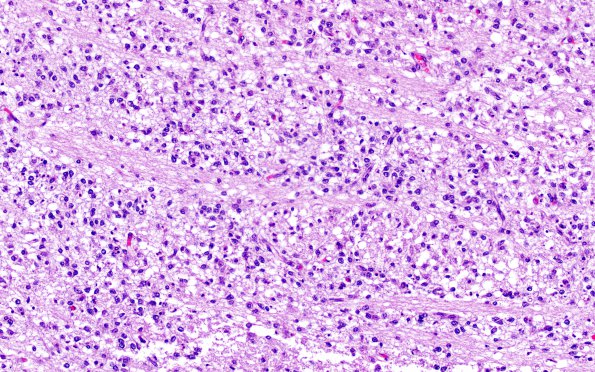 4C2 Hypoxia-ischemia, PSN (Case  4) H&E 5 (pons)