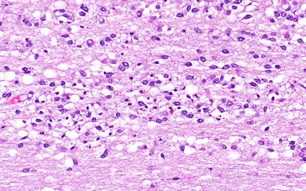 4C3 Hypoxia-ischemia, PSN (Case  4) H&E 5 (pons) 40X