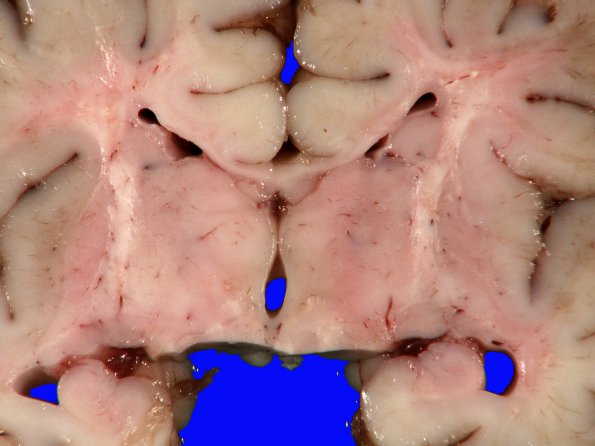 5A3 (Case  5) _7