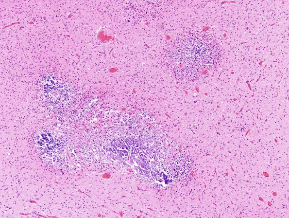 5A5 Hypoxia-Ischemia, neonatal, intrauterine (Case  5) H&E N12 3