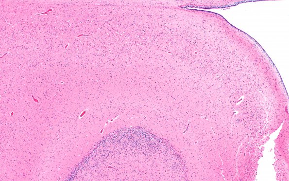 5B1 Hypoxia-Ischemia, neonatal, PSN intrauterine (Case  5) H&E N3 4X A