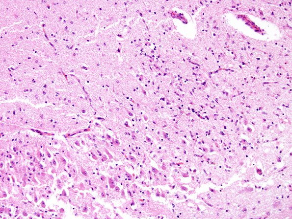 5B2 Hypoxia-Ischemia, neonatal, PSN intrauterine (Case  5) H&E N3 Sommer's sector