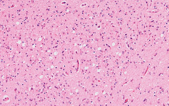 5B3 Hypoxia-Ischemia, neonatal, PSN intrauterine (Case  5) H&E N3 20X