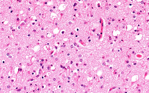 5B4 Hypoxia-Ischemia, neonatal, PSN intrauterine (Case  5) H&E N3 40X