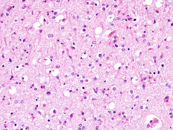 5B5 Hypoxia-Ischemia, neonatal, PSN intrauterine (Case  5) H&E N3 subiculum 1