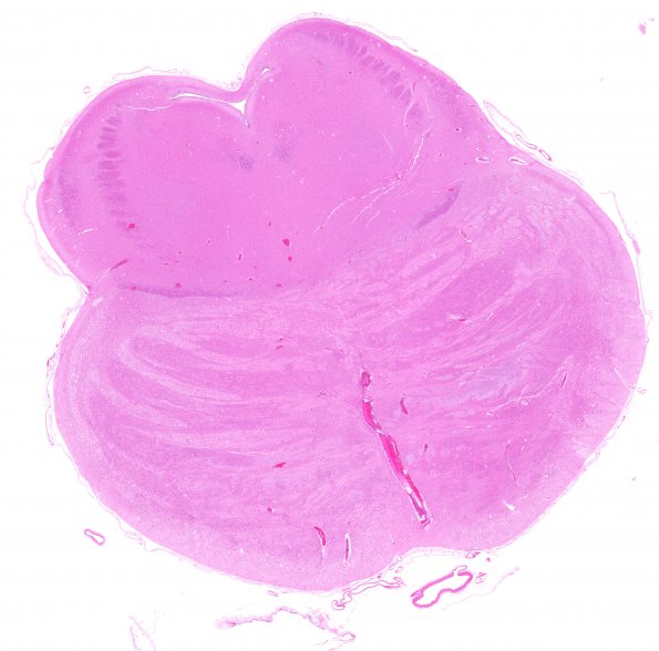 5C2 Hypoxia-Ischemia, neonatal, intrauterine (Case  5) H&E N7 whole mount