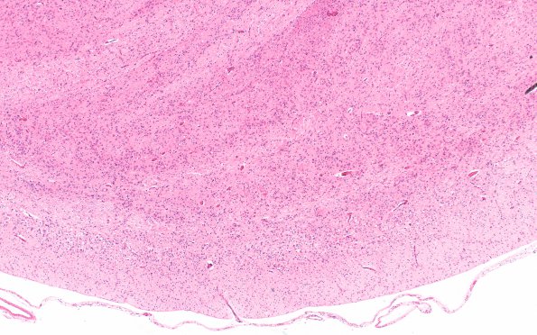 5C3 Hypoxia-Ischemia, neonatal, intrauterine (Case  5) H&E N7 pons 4X