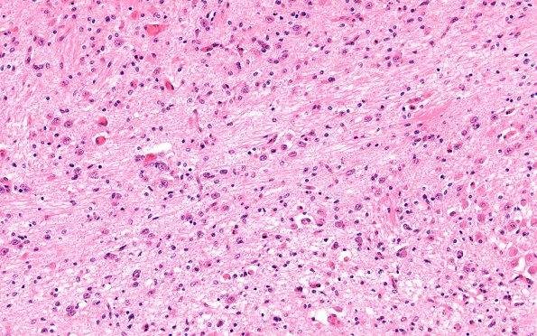 5C4 Hypoxia-Ischemia, neonatal, intrauterine (Case  5) H&E N7 pons 20X
