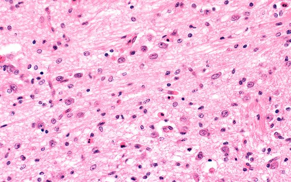 5C5 Hypoxia-Ischemia, neonatal, intrauterine (Case  5) H&E N7 pons 40X