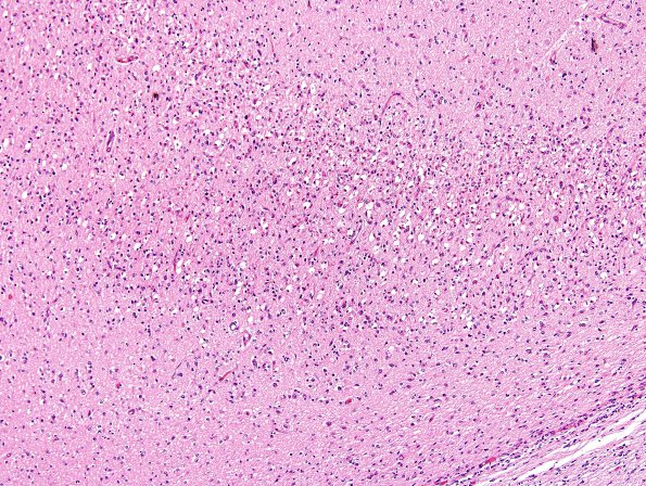 6A1 Hypoxia-Ischemia, neonatal, PSN (Case 6) Sub H&E 4.jpg