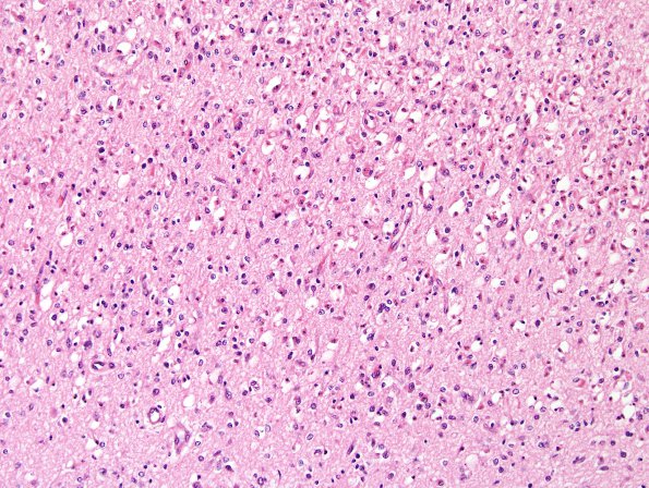 6A2 Hypoxia-Ischemia, neonatal, PSN (Case 6) Subiculum H&E 3